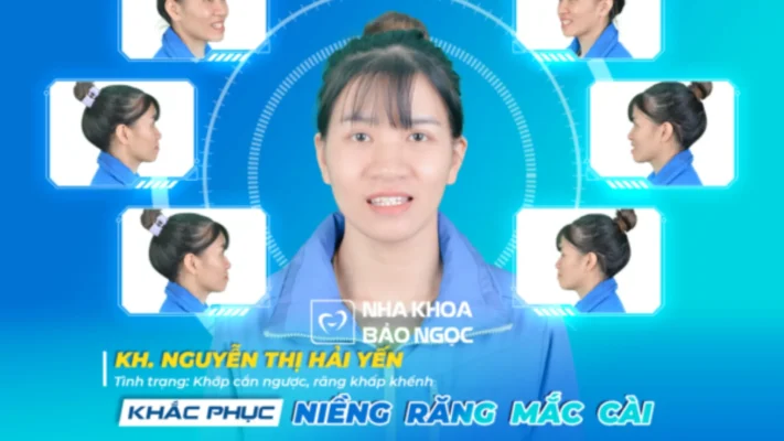Niềng răng tiết kiệm 26 triệu 930 ngàn, Hải Yến đã săn như nào?