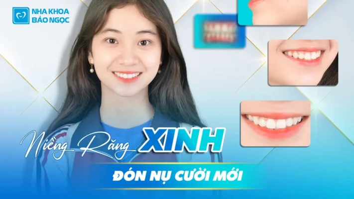 Niềng răng 2 năm Mừng Phương Linh tháo niềng