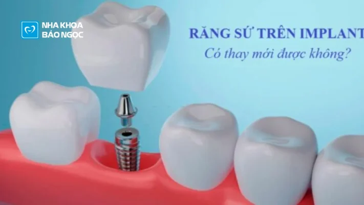 Răng sứ trên Implant có thay mới được không?