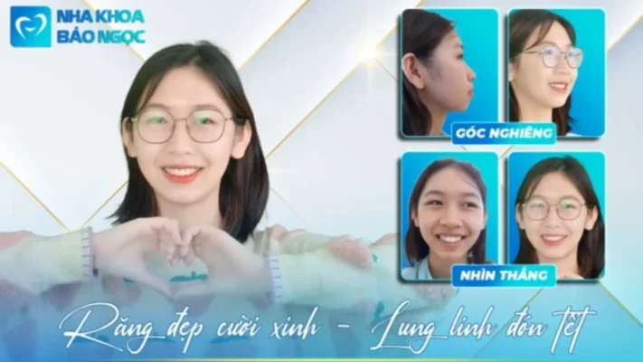 Niềng răng để có răng đẹp, cười xinh 100% cùng Hoàng Linh
