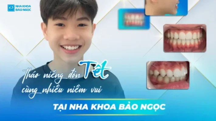 Niềng răng để "Dậy thì thành công 100%" cùng Bảo Lâm