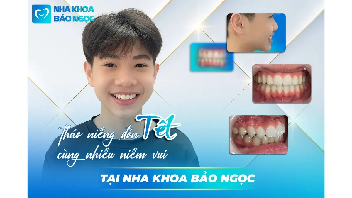 Niềng răng để "Dậy thì thành công" cùng Bảo Lâm