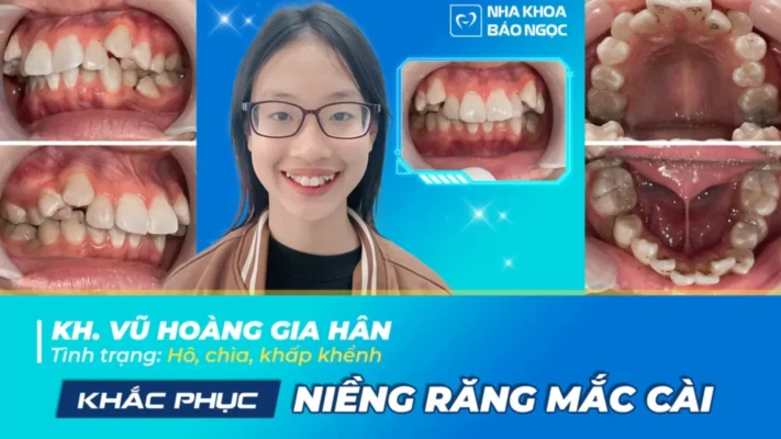 Niềng răng sớm cùng Gia Hân 15 tuổi