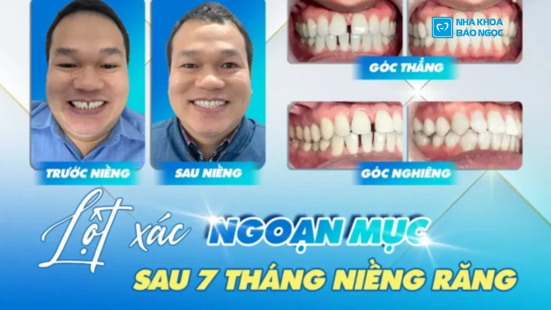 Tháo niềng răng chỉ sau 7 tháng cùng anh Đình Thi