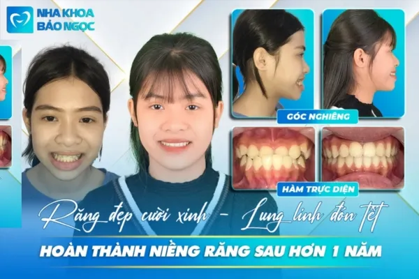 Mừng Thanh Mai tháo niềng răng chỉ sau hơn 1 năm