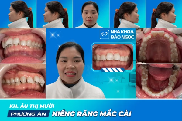 Nhiều tuổi có niềng răng được không?