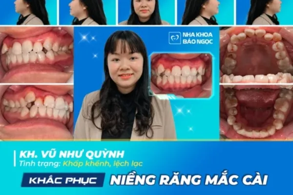 Như Quỳnh chọn niềng răng để có nụ cười khoẻ đẹp