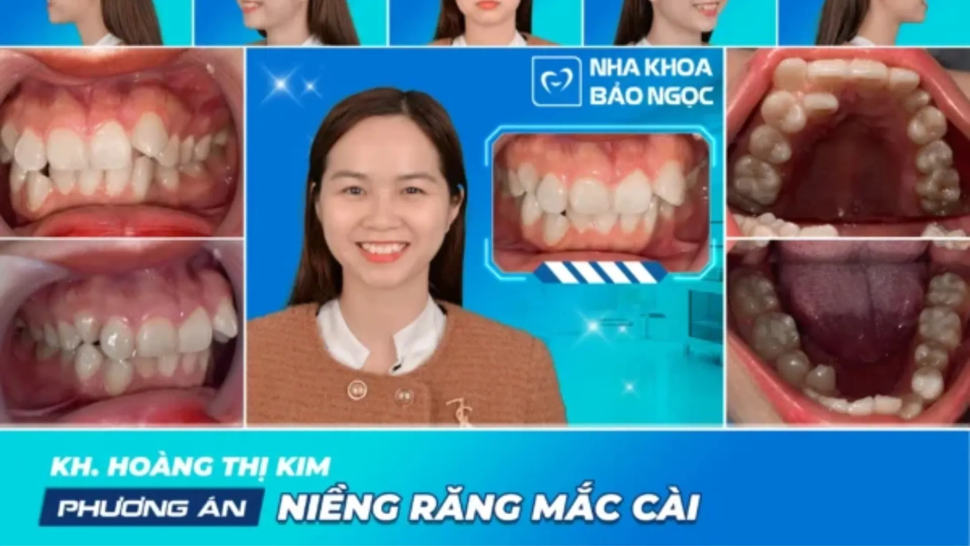 Niềng răng mắc cài có khoá cùng Hoàng Kim