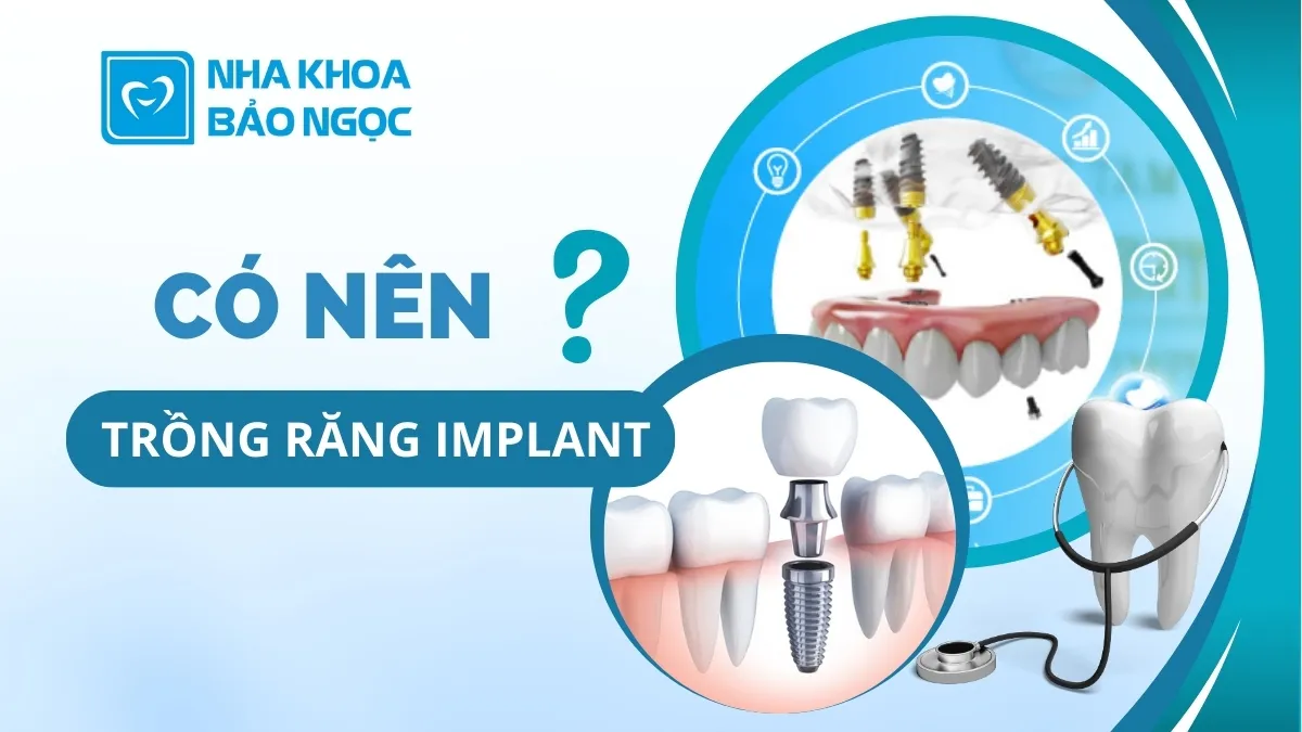 Nên trồng răng Implant không 