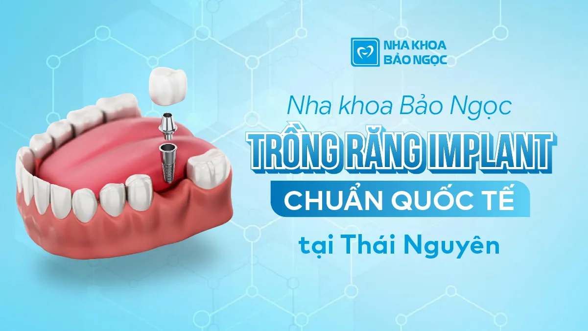 Nha khoa Bảo Ngọc trồng răng Implant uy tín tại Thái Nguyên