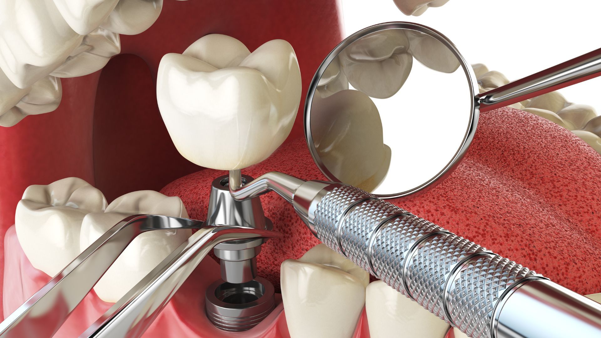Chi phí trồng răng Implant
