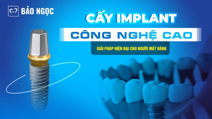 Cấy Implant công nghệ cao