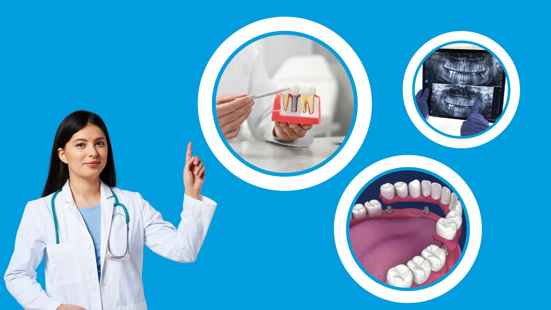 Chi phí trồng răng Implant