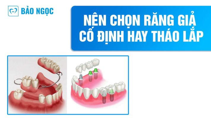 Nên chọn răng giả cố định hay tháo lắp