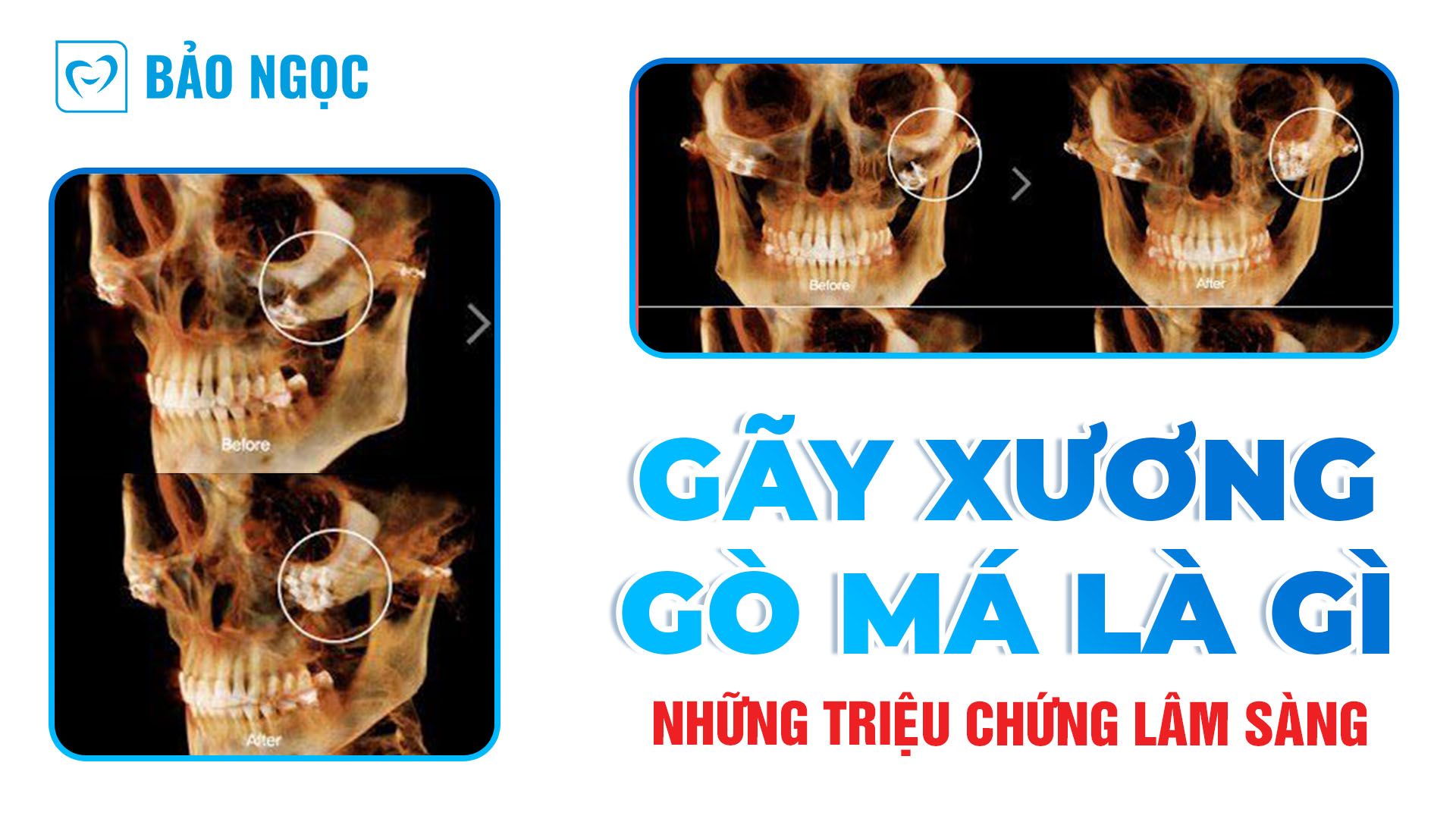 gãy xương gò má