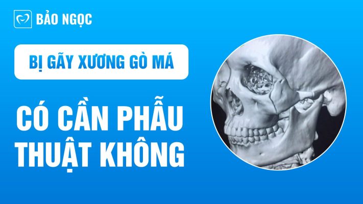 Bị gãy xương gò má