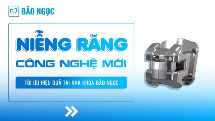 Niềng răng công nghệ mới