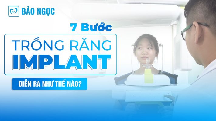 quy trình trồng răng Implant