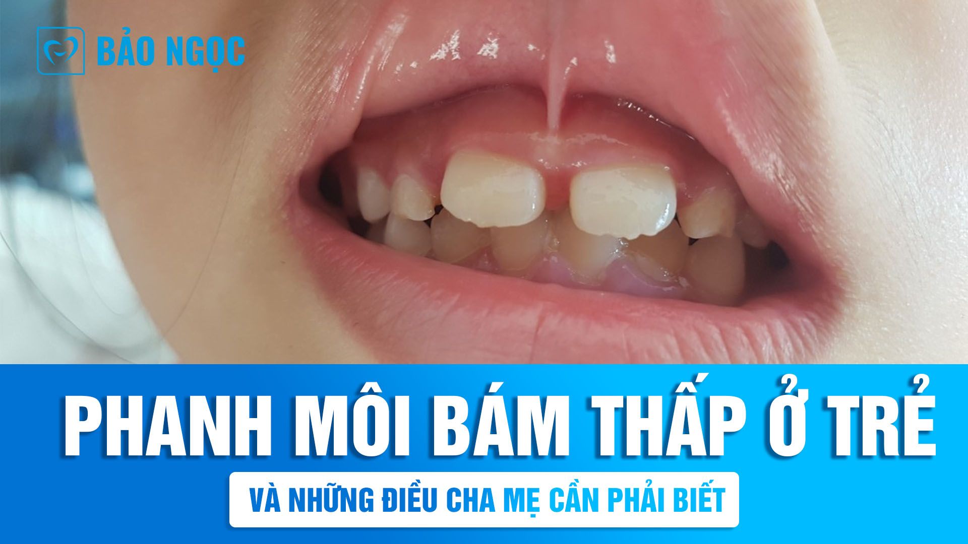 Phanh môi bám thấp ở trẻ