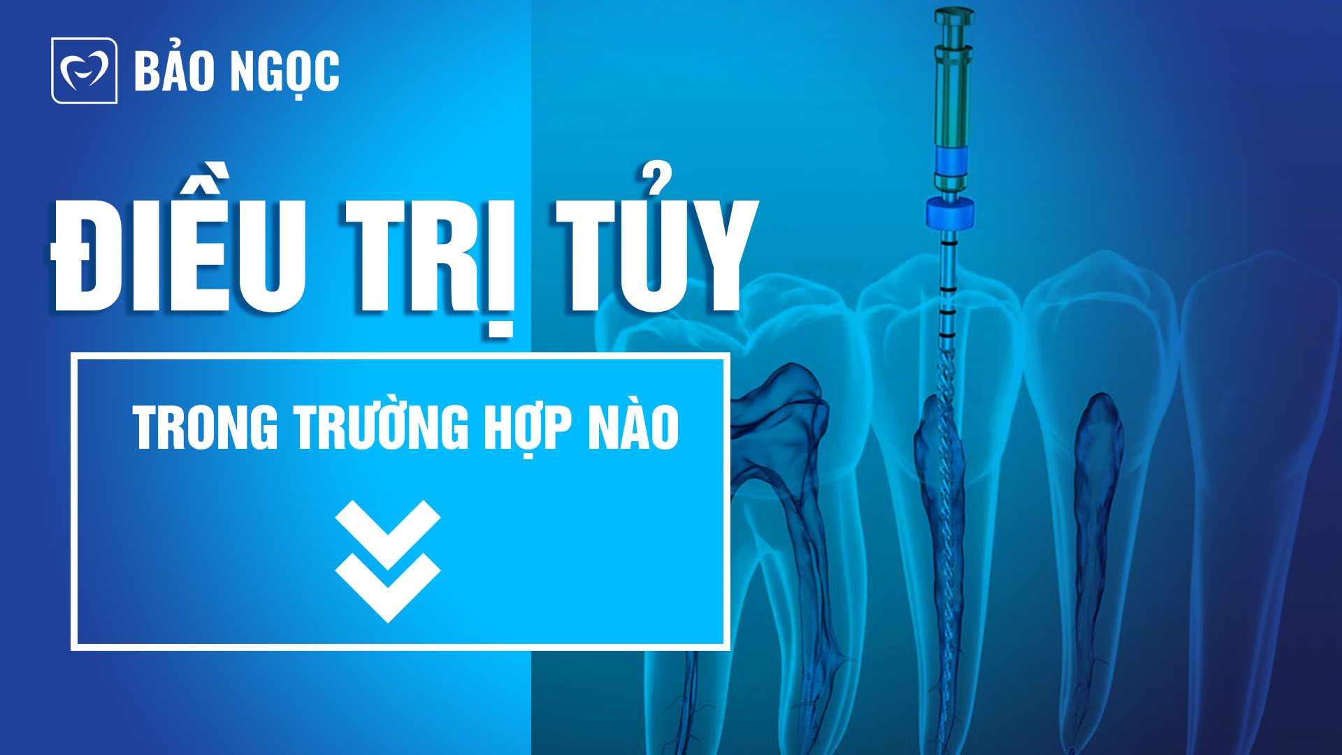 Điều trị tủy