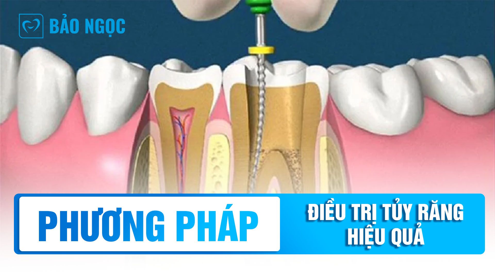 Phương pháp điều trị tủy răng hiệu quả tại Nha khoa Bảo Ngọc