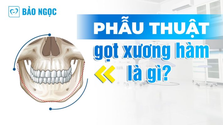 Phẫu thuật gọt xương hàm