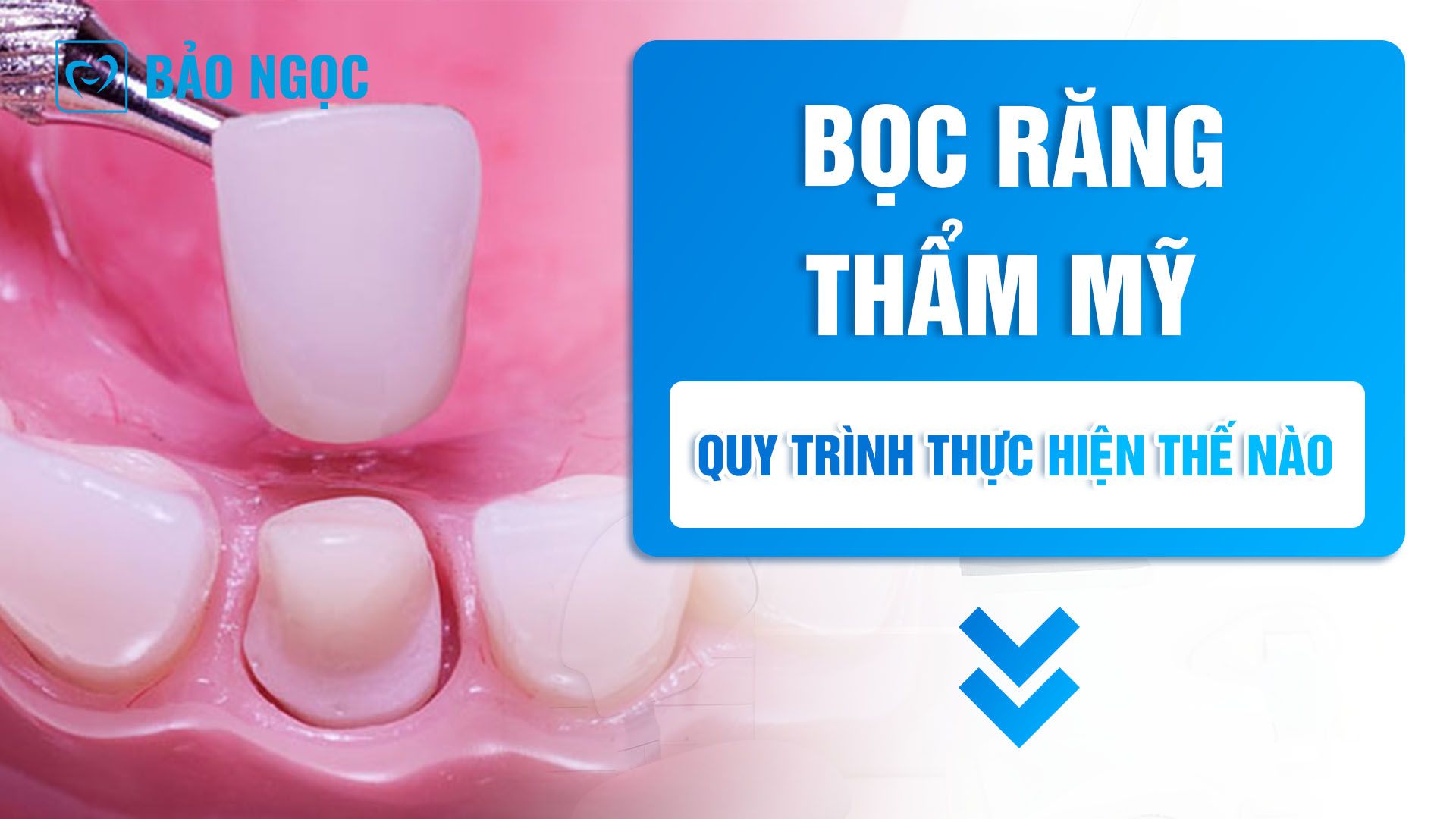 Bọc răng thẩm mỹ 