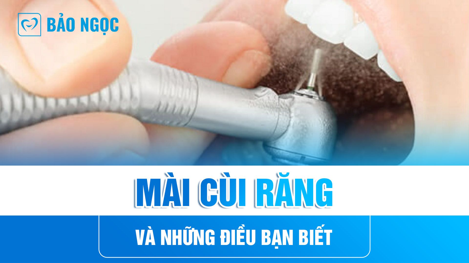  Mài cùi răng và những điều bạn biết trước khi làm răng thẩm mỹ 