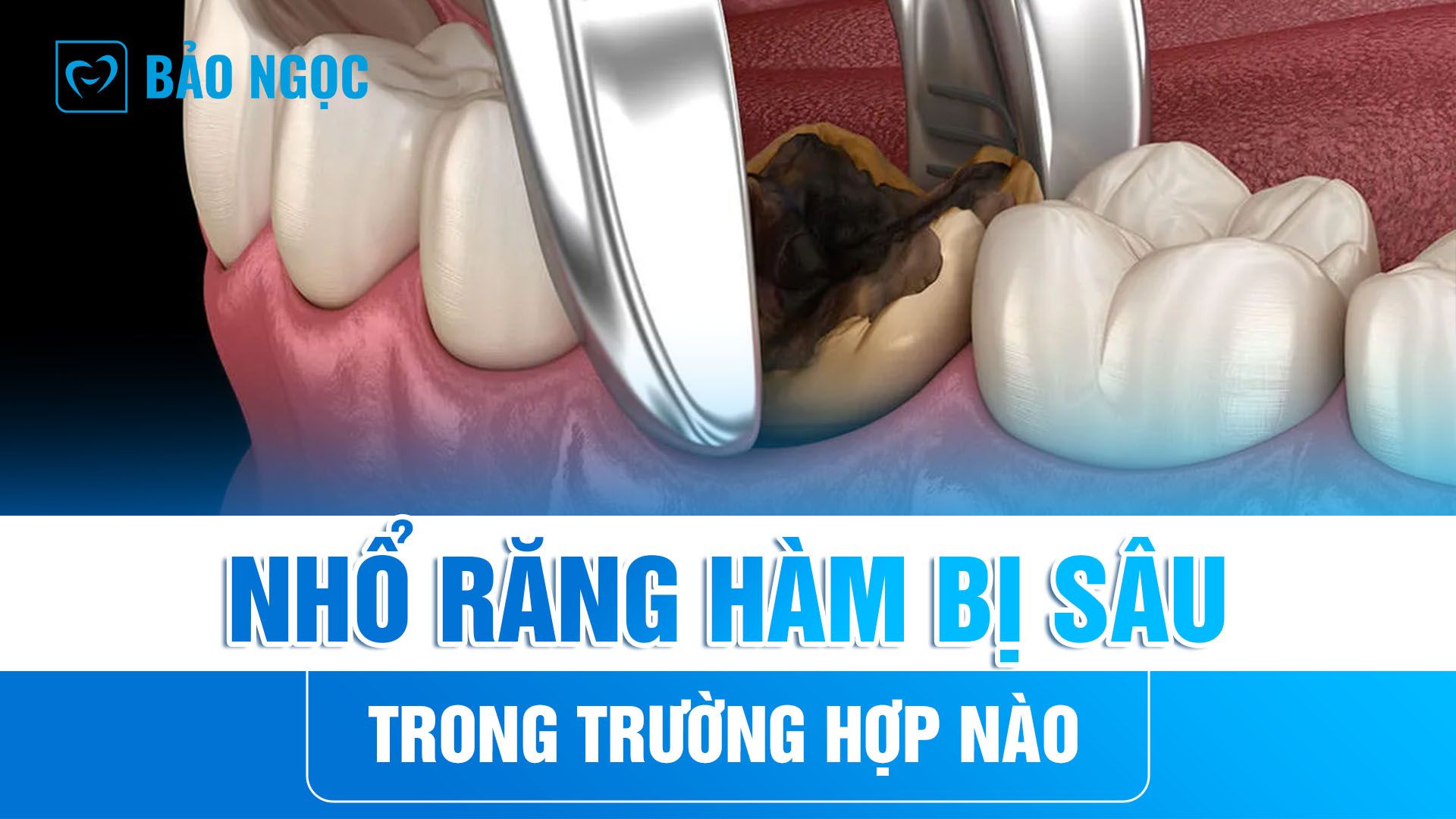 Nhổ răng hàm bị sâu trong trường hợp nào? Quy trình và lưu ý thực hiện