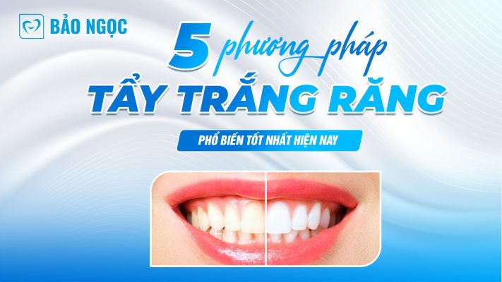 phương pháp tẩy trắng răng