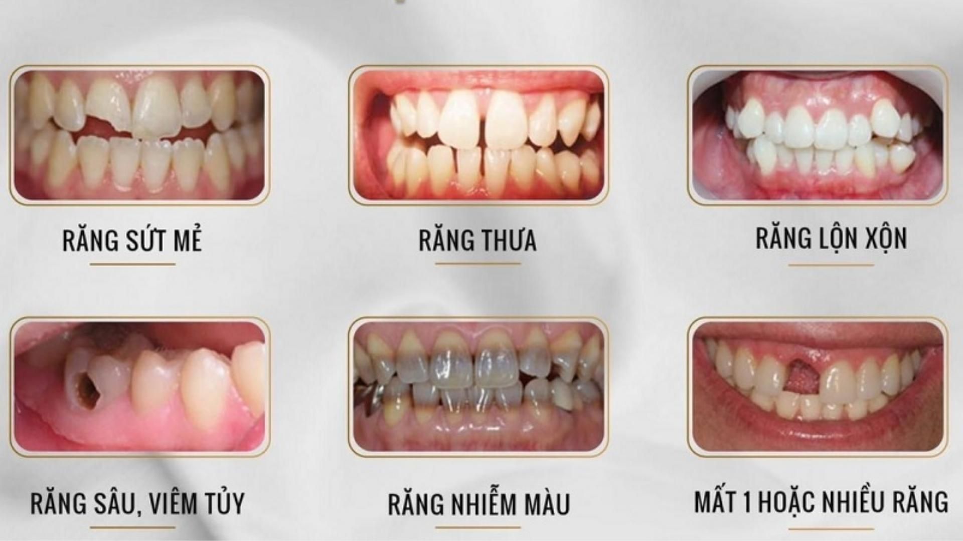 Răng sứ Thẩm mỹ