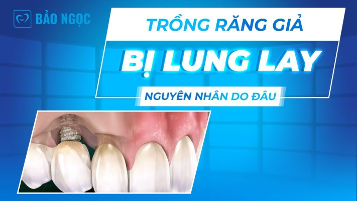 Trồng răng giả bị lung lay