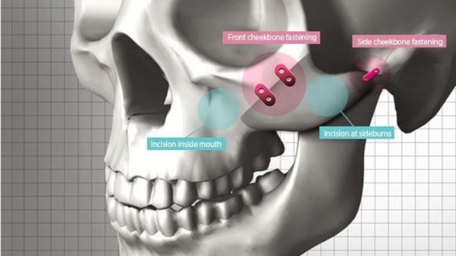 Phức hợp gò má là gì? Nguyên nhân và triệu chứng như thế nào?