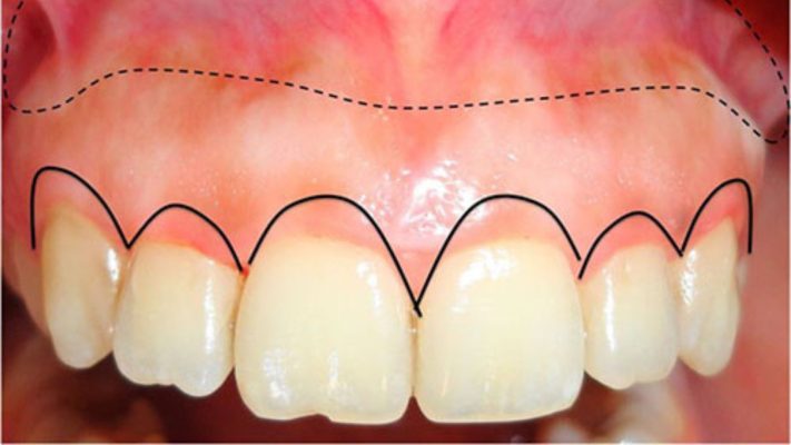 phẫu thuật cười hở lợi