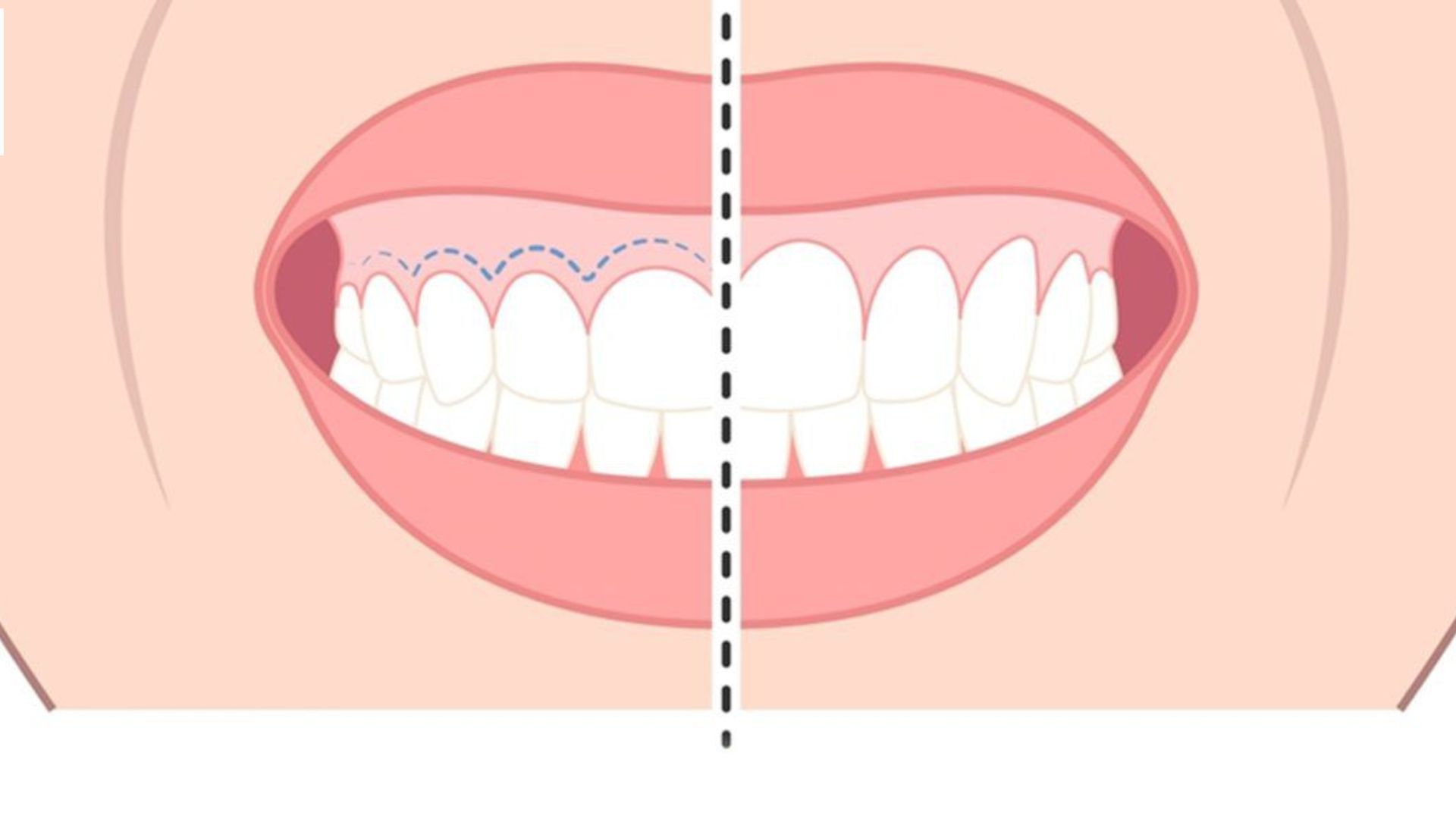 Cắt cười hở lợi