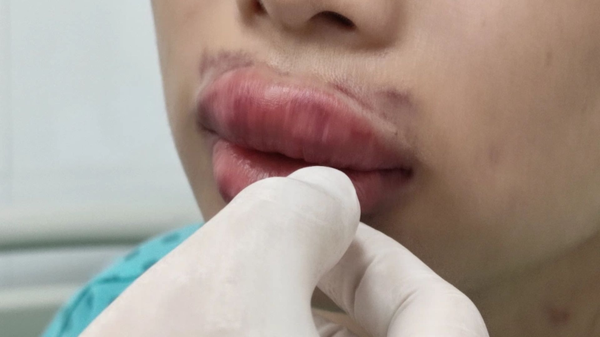 Cắt môi trái tim bị hở răng gây ra hậu quả gì? Giải pháp khắc phục