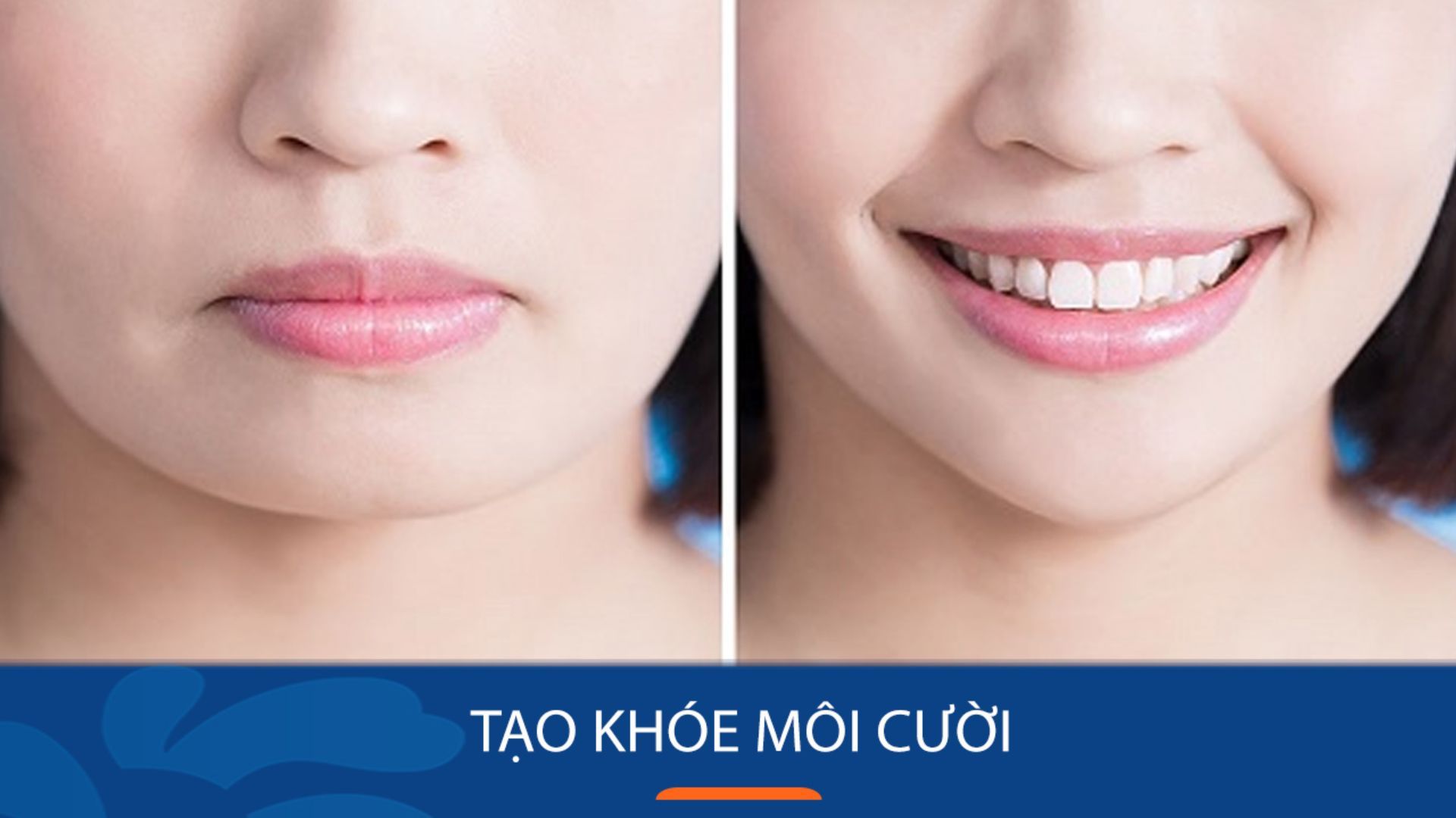 Tạo khóe môi cười: Giải pháp thẩm mỹ cho nụ cười duyên dáng
