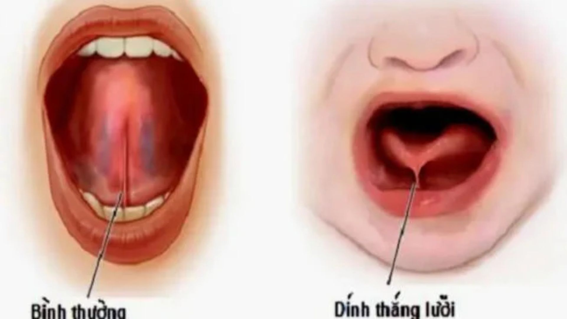 Cắt thắng môi, thắng lưỡi cần lưu ý những gì? Khi nào nên thực hiện