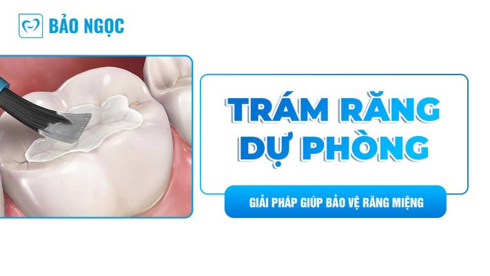 Trám răng dự phòng