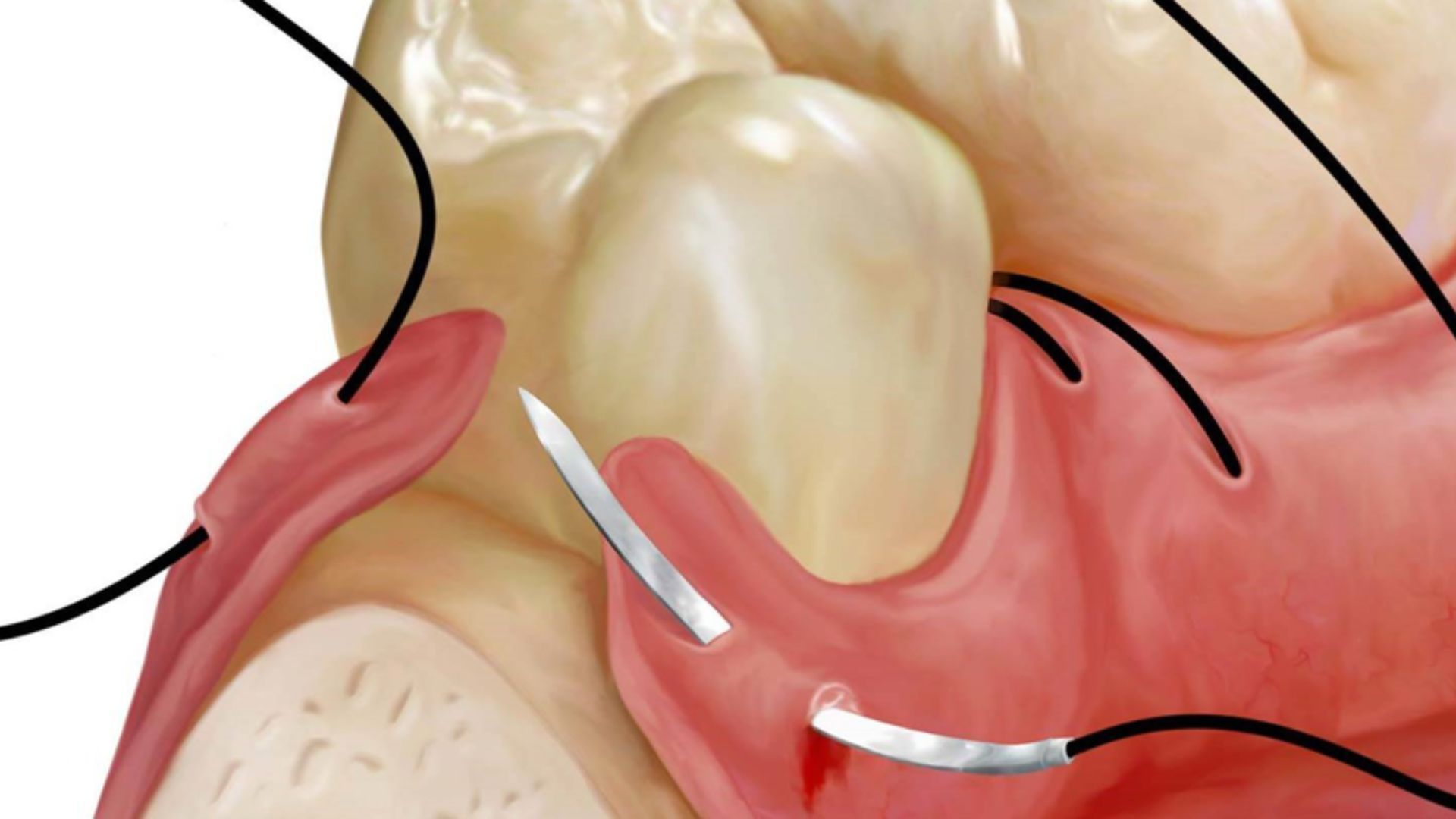 Chỉ khâu răng khôn bị đứt cách xử lý thế nào? Những lưu ý quan trọng