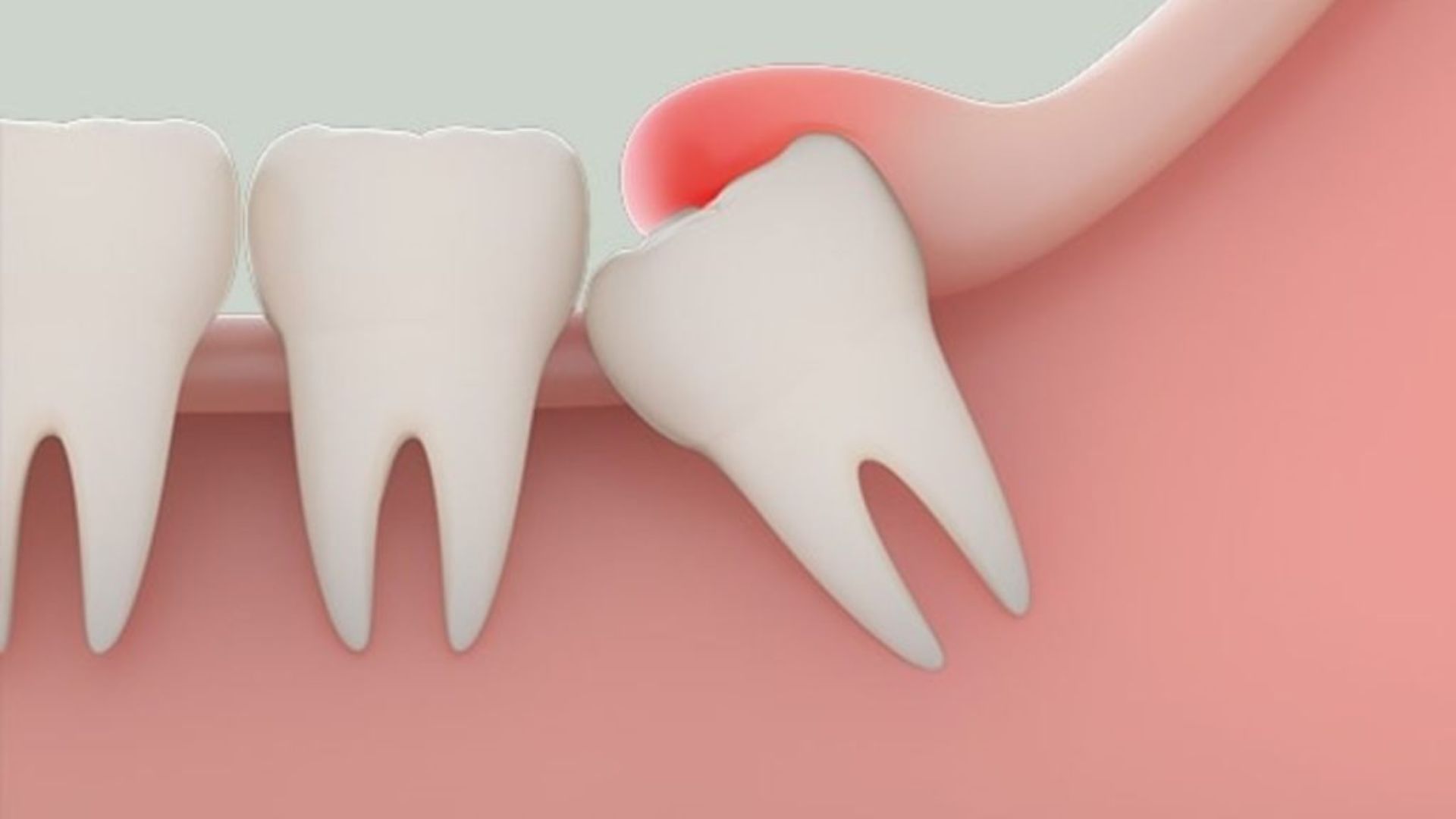 Địa chỉ nhổ răng khôn uy tín tại Nha Khoa Bảo Ngọc lựa chọn hàng đầu 