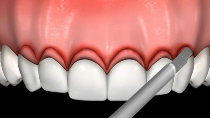 Cắt nướu răng là gì? Thủ thuật và lợi ích thực hiện phương pháp thẩm mỹ 