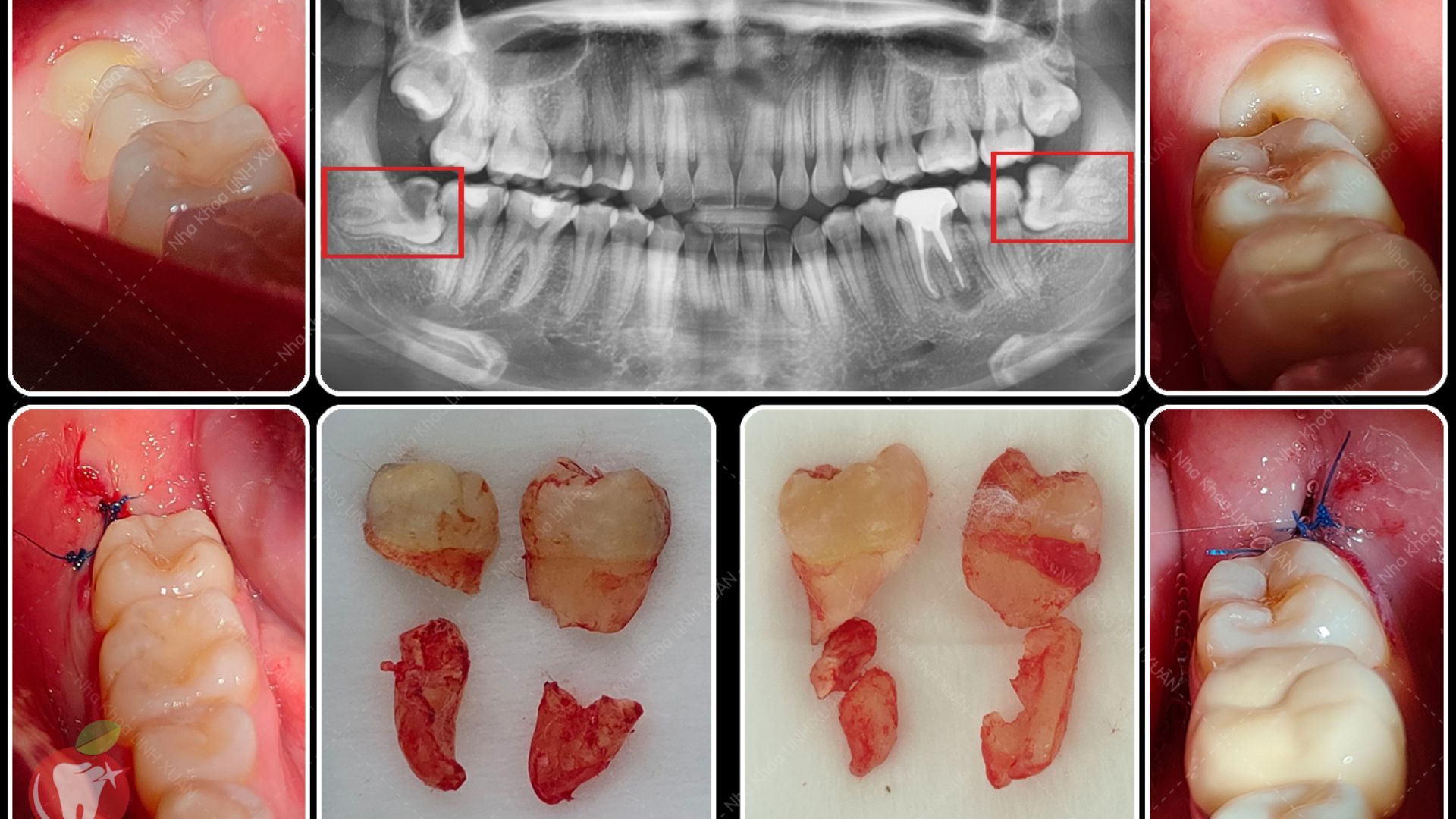 Nhổ răng khôn không đau với quy trình thực hiện an toàn và hiệu quả 