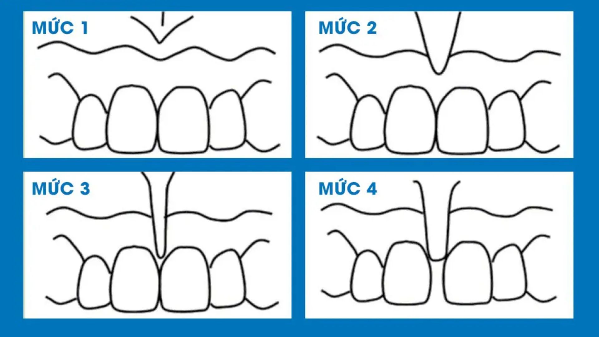 Cắt phanh môi là gì? Điều cần biết về phanh môi và thực hiện an toàn