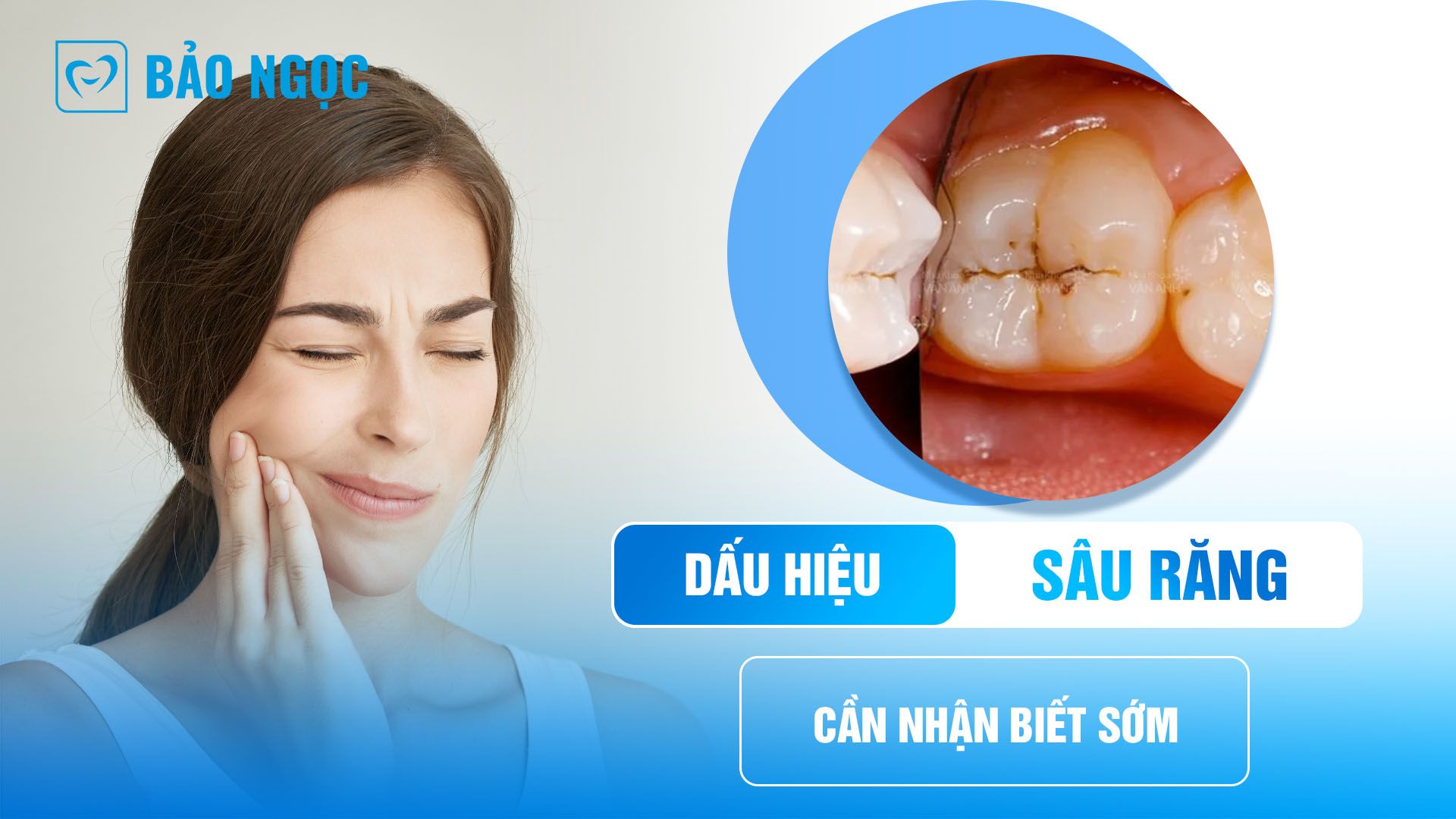 Dấu hiệu sâu răng: Nhận biết sớm để bảo vệ sức khỏe răng miệng