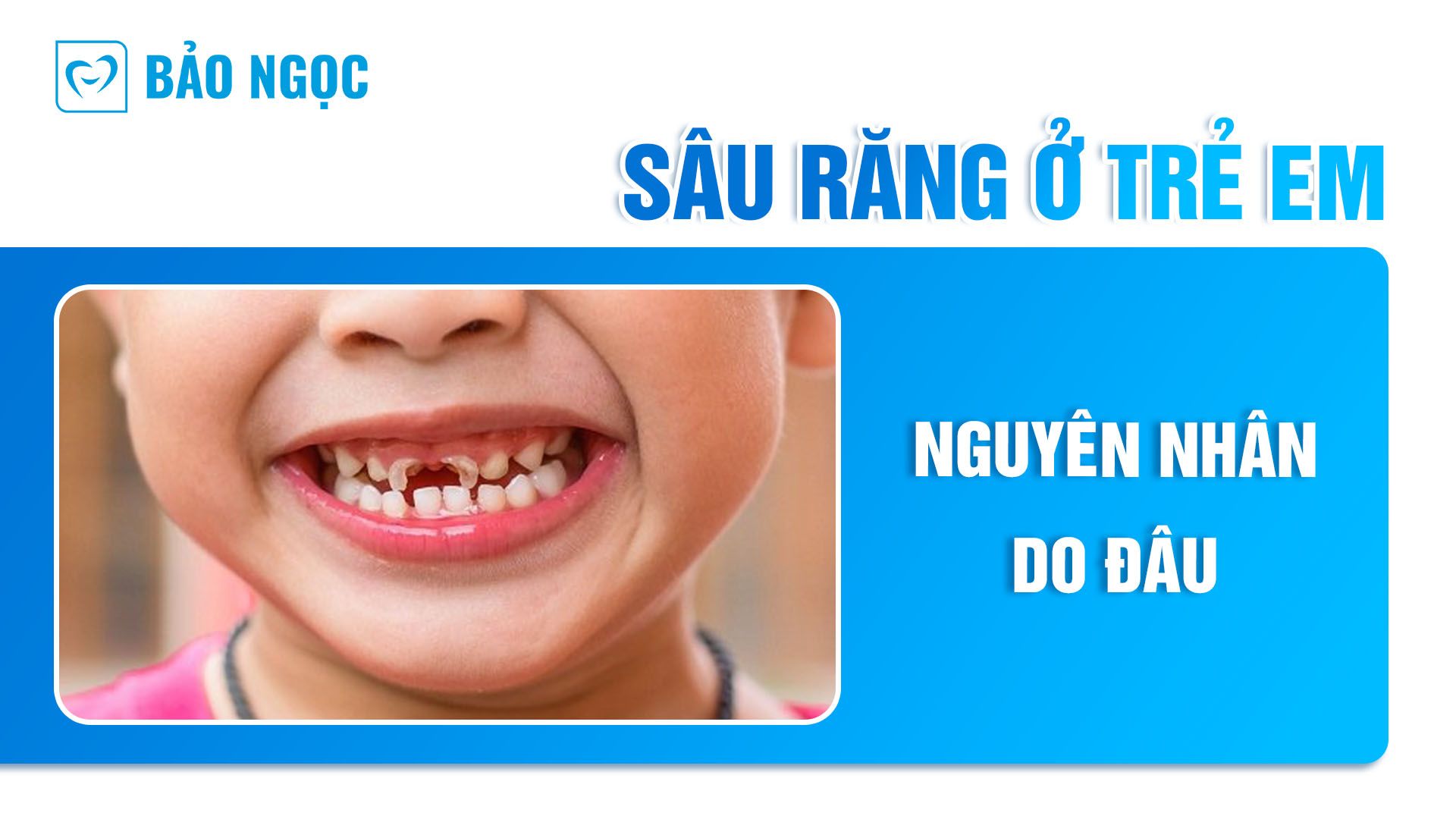 Sâu răng ở trẻ em do nguyên nhân gì? Dấu hiệu và phòng ngừa tác hại 