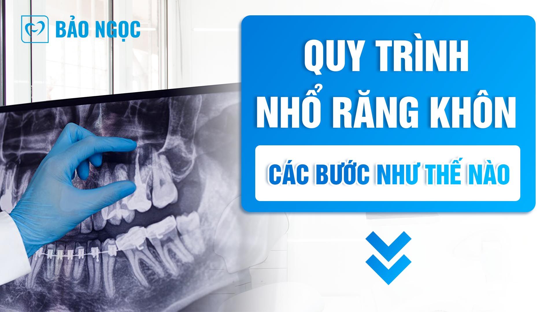 Quy trình nhổ răng khôn