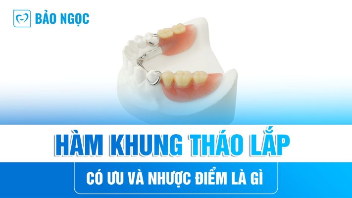 Hàm khung tháo lắp