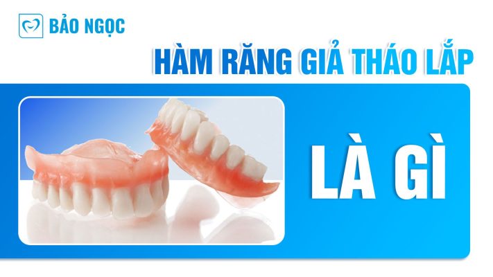 Hàm răng giả tháo lắp