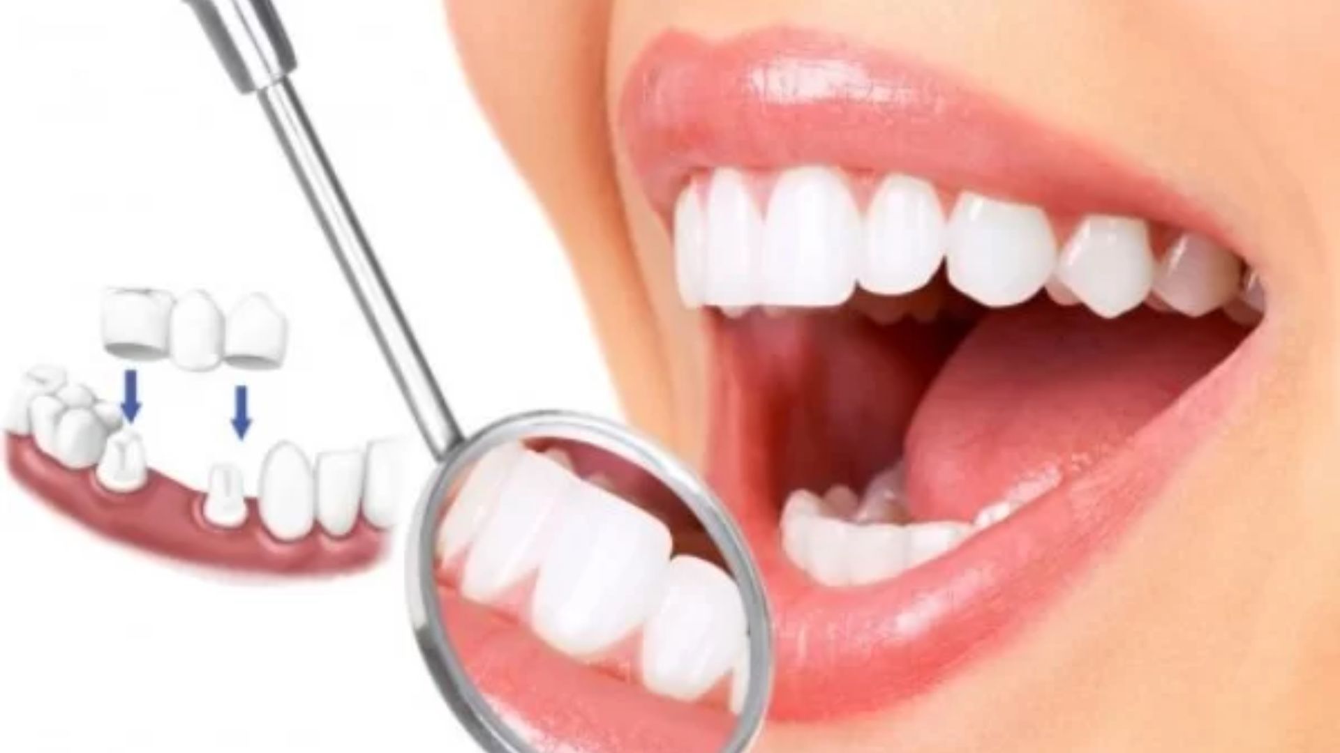 Răng sứ Thẩm mỹ